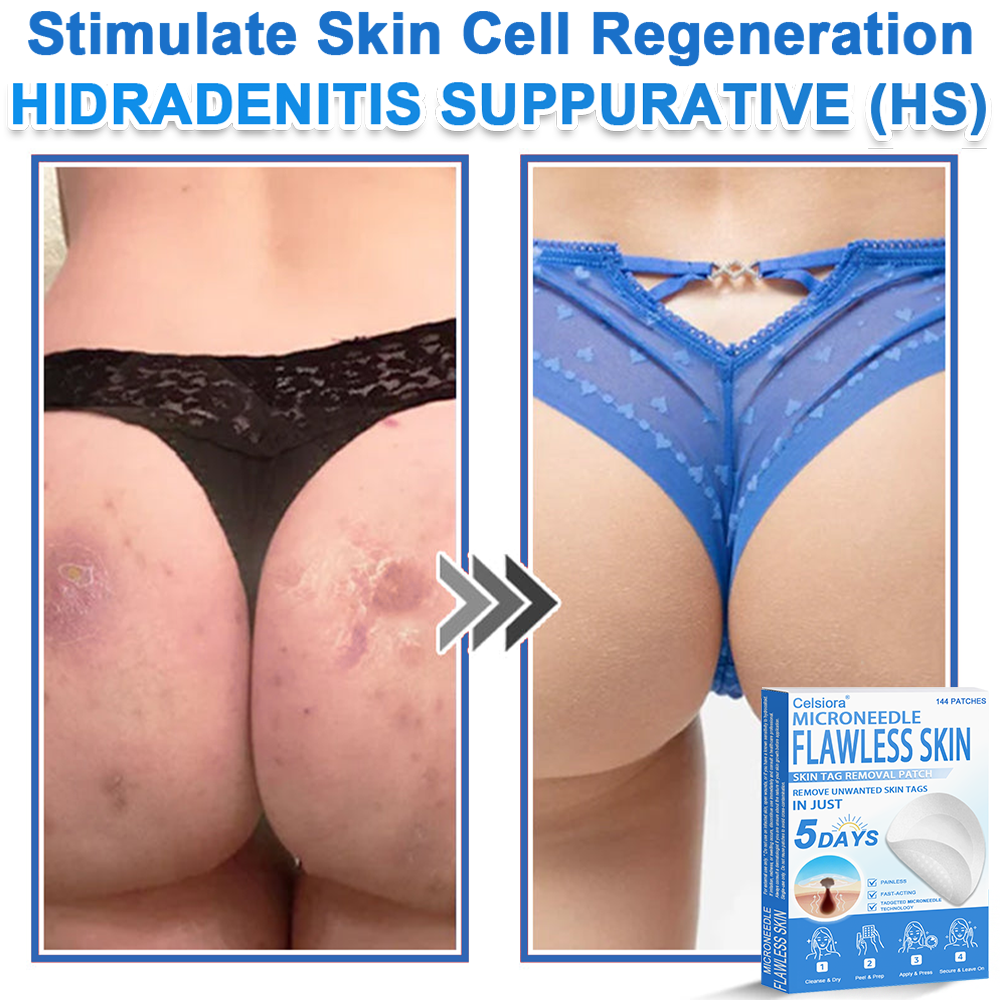 ⭐Celsiora® 2-in-1 Microneedle & Hydrocolloid Patch | Raised Moles,Acne,  Flat Warts & Skin Tags Remover | Improves Wrinkles, Scars & Blemishes | Invisible Star Pimple Patches for Face & Body