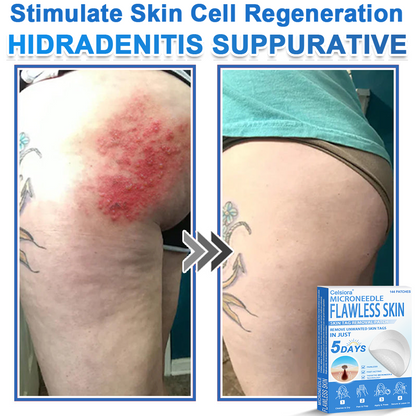 ⭐Celsiora® 2-in-1 Microneedle & Hydrocolloid Patch | Raised Moles,Acne,  Flat Warts & Skin Tags Remover | Improves Wrinkles, Scars & Blemishes | Invisible Star Pimple Patches for Face & Body
