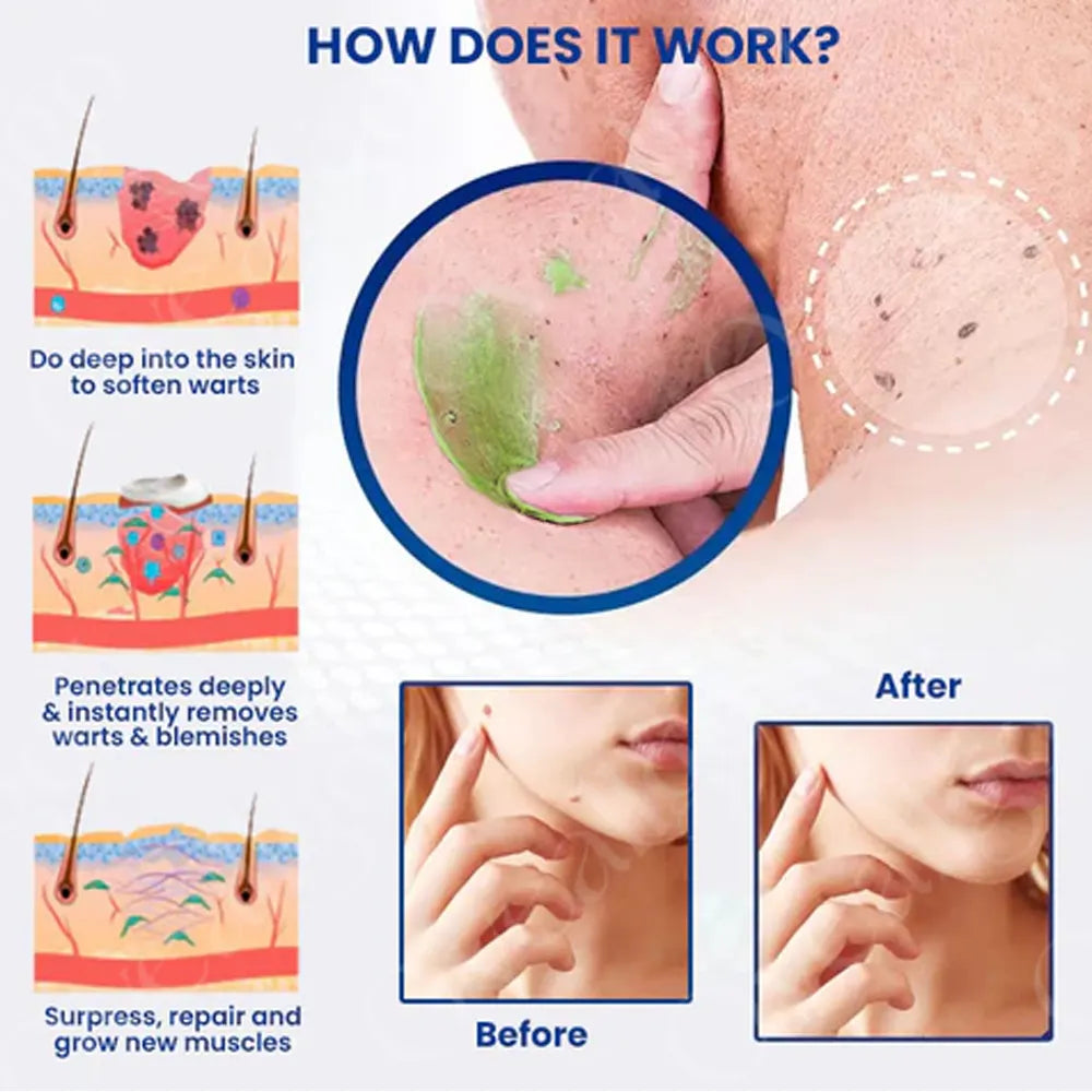 ✅ Official Store: FivfivgoTM NatureErase Instant Mole & Spot Removal Gel