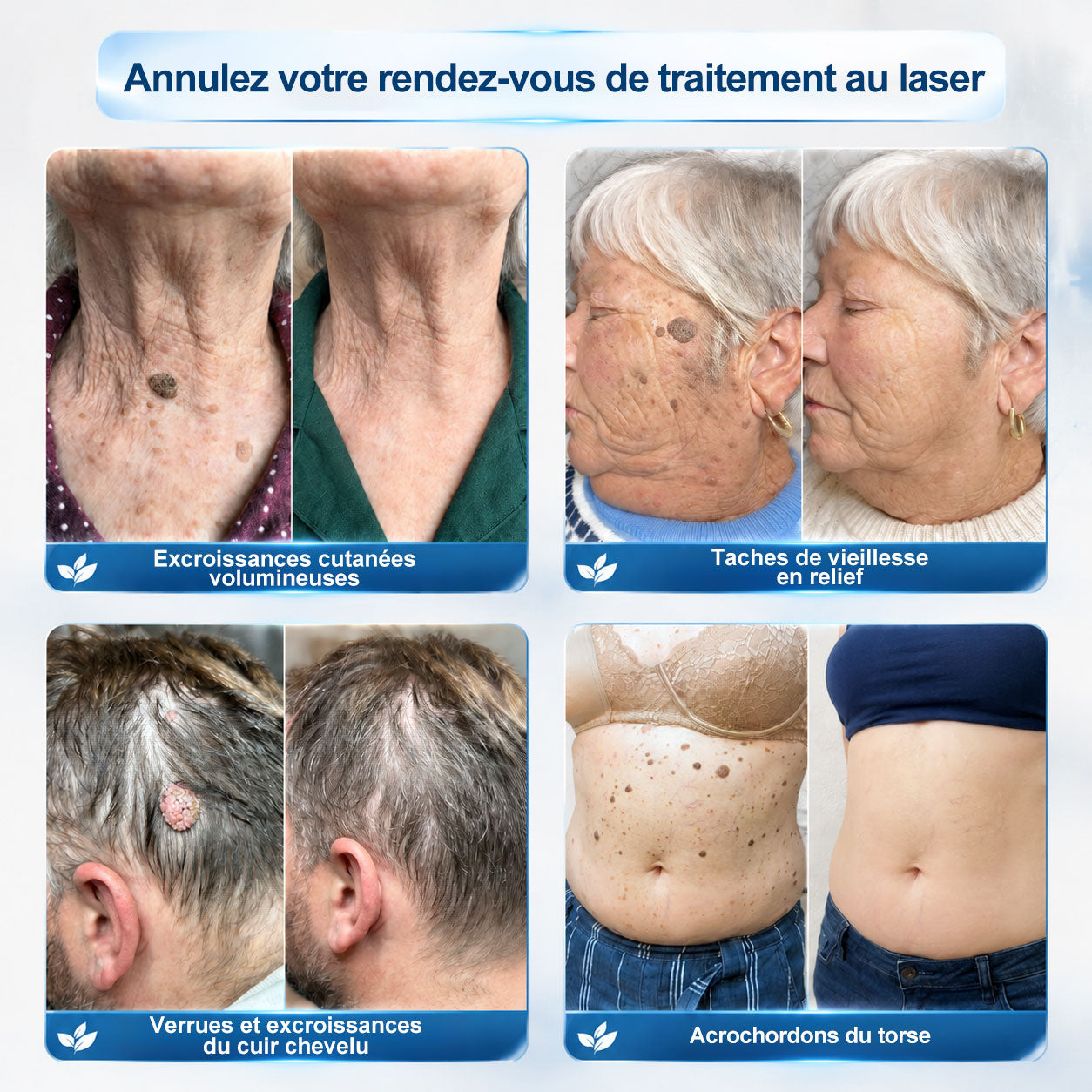 Boutique officielle de la marque (Belgique) |✏️𝐏i𝐜𝐝o® 7 Jours Effaceur de taches et d’excroissances cutanées(Zéro douleur, zéro cicatrice – Roller)