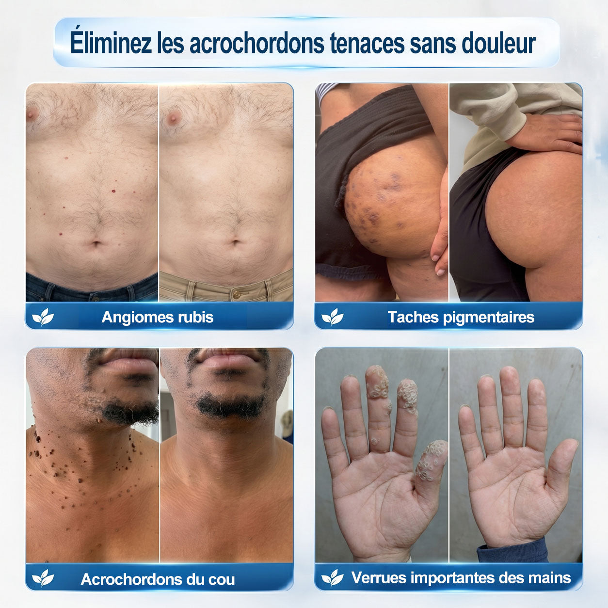 Boutique officielle de la marque (Belgique) |✏️𝐏i𝐜𝐝o® 7 Jours Effaceur de taches et d’excroissances cutanées(Zéro douleur, zéro cicatrice – Roller)