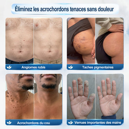 Boutique officielle de la marque (Belgique) |✏️𝐏i𝐜𝐝o® 7 Jours Effaceur de taches et d’excroissances cutanées(Zéro douleur, zéro cicatrice – Roller)