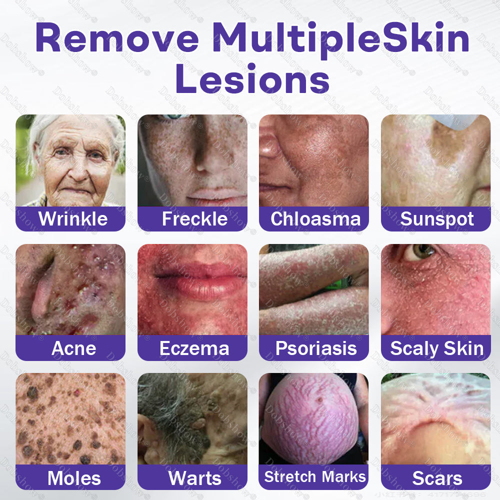 🏅𝙏𝙂𝘼 𝘼𝙥𝙥𝙧𝙤𝙫𝙚𝙙 | Dobshow® Wart and mole removal microneedle patch