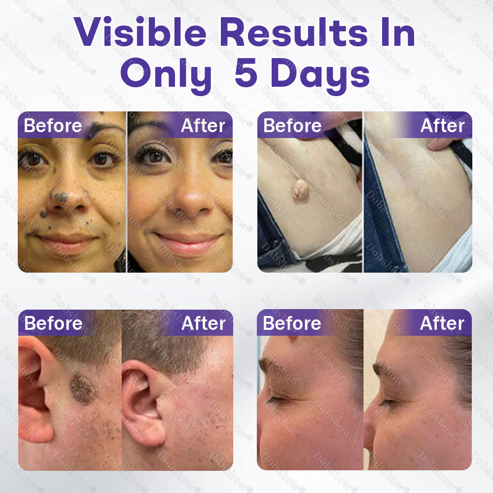 🏅𝙏𝙂𝘼 𝘼𝙥𝙥𝙧𝙤𝙫𝙚𝙙 | Dobshow® Wart and mole removal microneedle patch