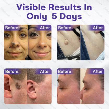 🏅𝙏𝙂𝘼 𝘼𝙥𝙥𝙧𝙤𝙫𝙚𝙙 | Dobshow® Wart and mole removal microneedle patch