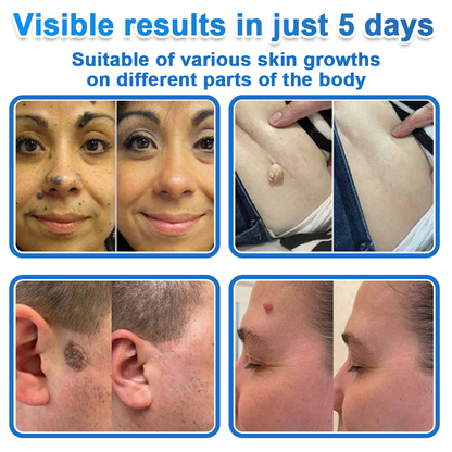 ⭐Celsiora® 2-in-1 Microneedle & Hydrocolloid Patch | Raised Moles,Acne,  Flat Warts & Skin Tags Remover | Improves Wrinkles, Scars & Blemishes | Invisible Star Pimple Patches for Face & Body