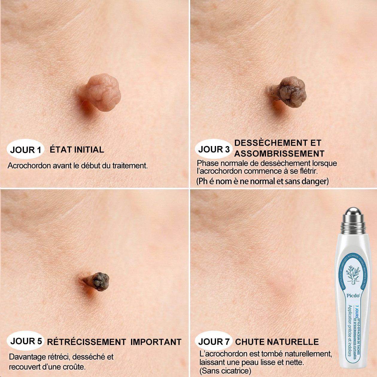 Boutique officielle de la marque (Belgique) |✏️𝐏i𝐜𝐝o® 7 Jours Effaceur de taches et d’excroissances cutanées(Zéro douleur, zéro cicatrice – Roller)