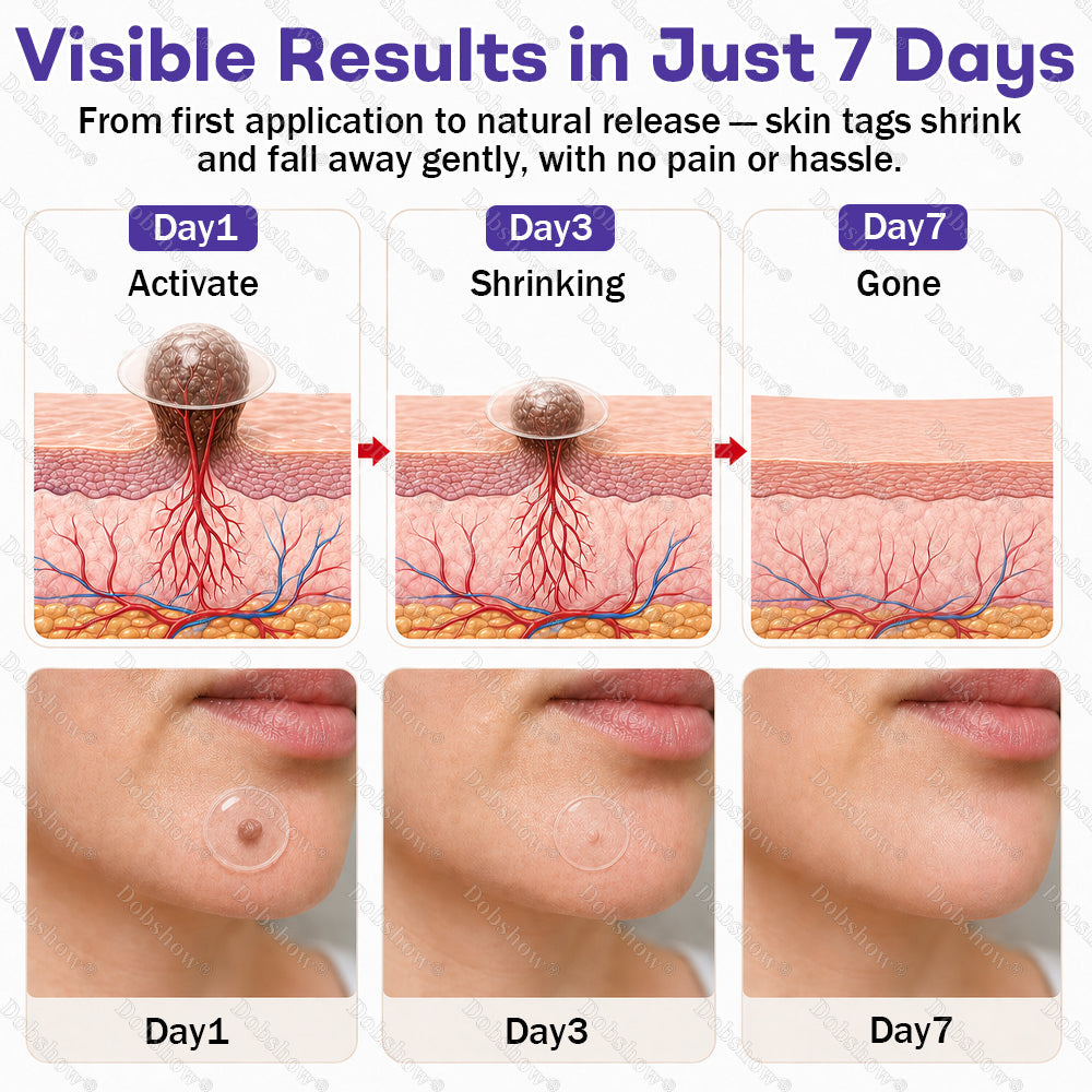 🏅𝙏𝙂𝘼 𝘼𝙥𝙥𝙧𝙤𝙫𝙚𝙙 | Dobshow® Wart and mole removal microneedle patch