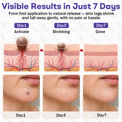 🏅𝙏𝙂𝘼 𝘼𝙥𝙥𝙧𝙤𝙫𝙚𝙙 | Dobshow® Wart and mole removal microneedle patch