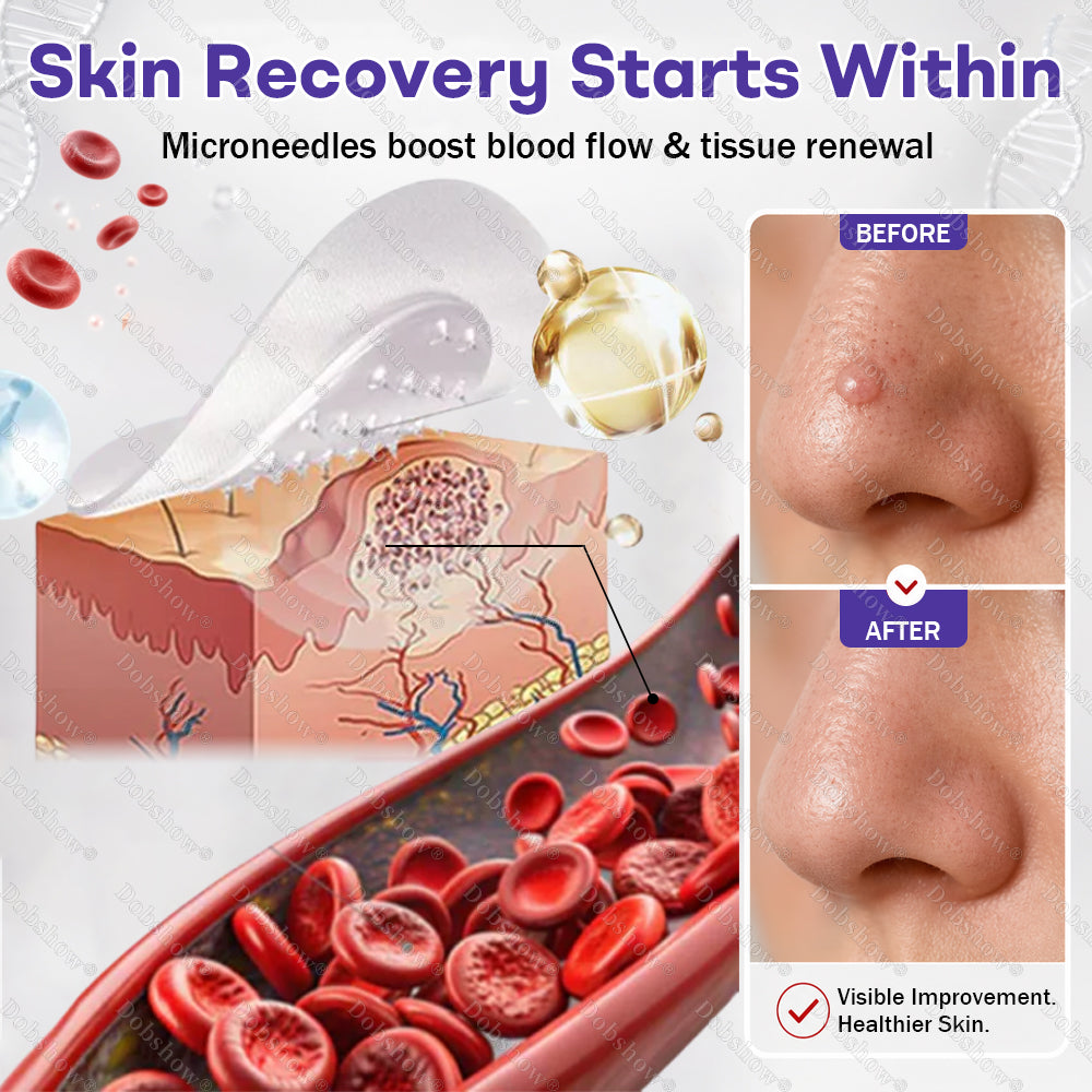 🏅𝙏𝙂𝘼 𝘼𝙥𝙥𝙧𝙤𝙫𝙚𝙙 | Dobshow® Wart and mole removal microneedle patch