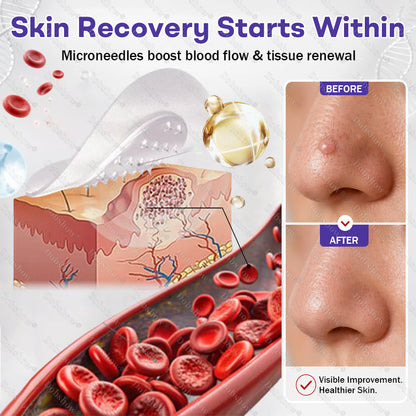 🏅𝙏𝙂𝘼 𝘼𝙥𝙥𝙧𝙤𝙫𝙚𝙙 | Dobshow® Wart and mole removal microneedle patch