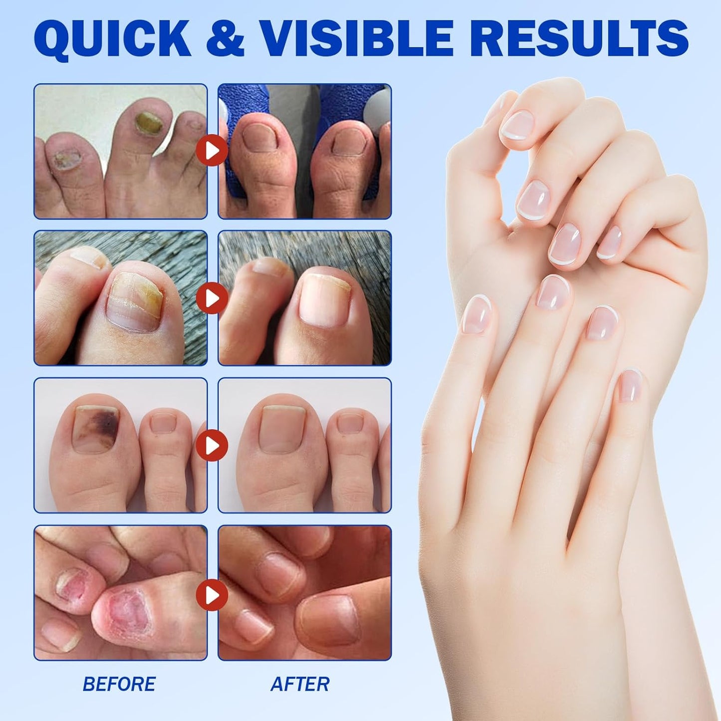 Onychomycosis stickers
