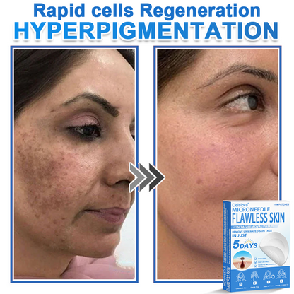 ⭐Celsiora® 2-in-1 Microneedle & Hydrocolloid Patch | Raised Moles,Acne,  Flat Warts & Skin Tags Remover | Improves Wrinkles, Scars & Blemishes | Invisible Star Pimple Patches for Face & Body